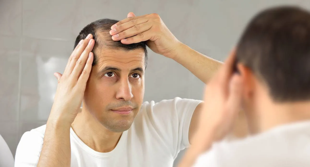 Male Pattern Baldness