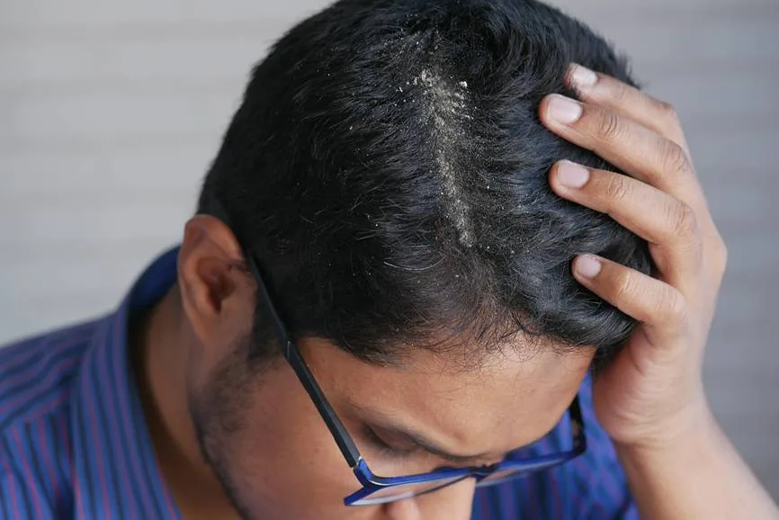 Scalp Psoriasis