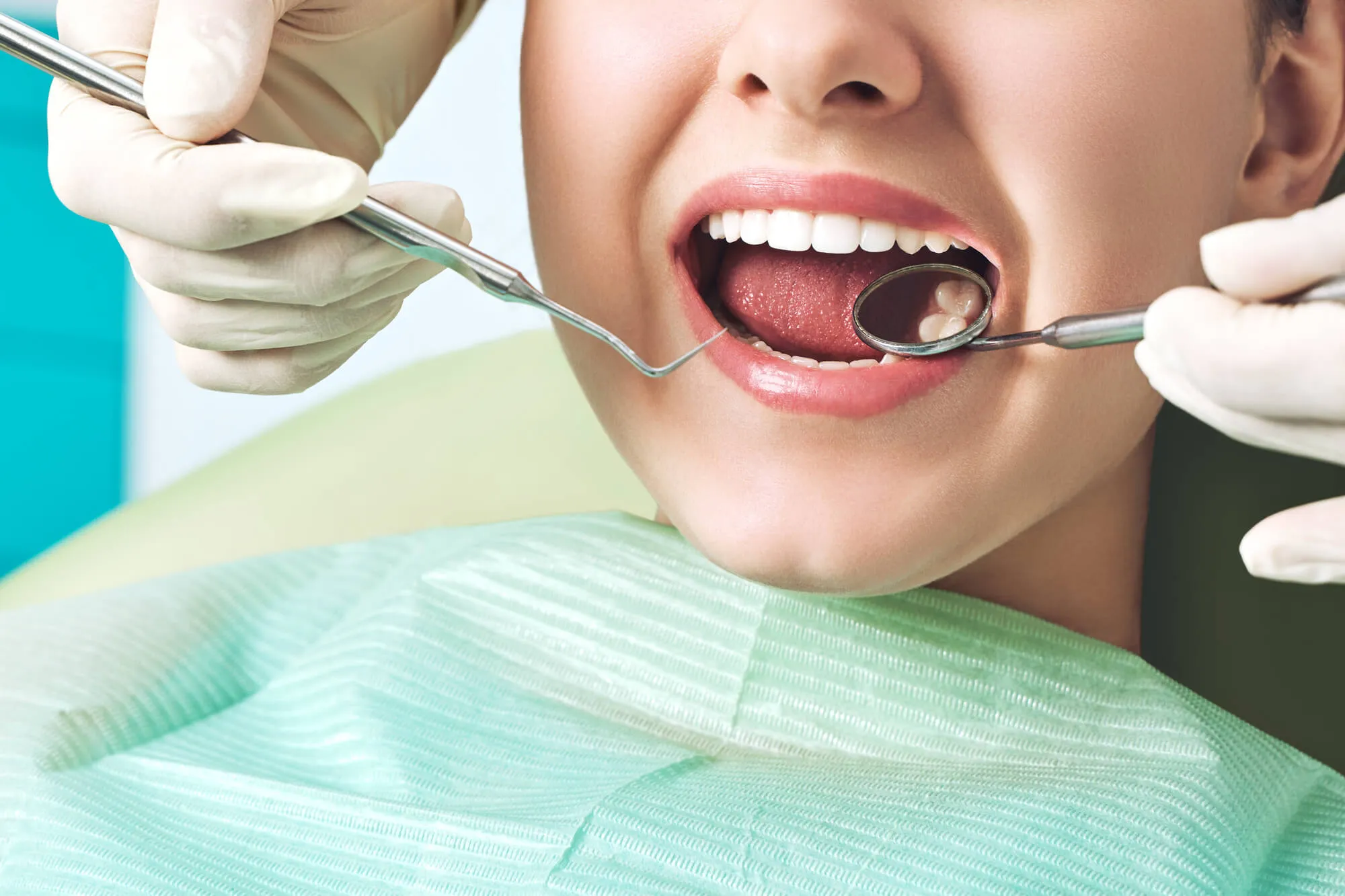 Dental Fillings