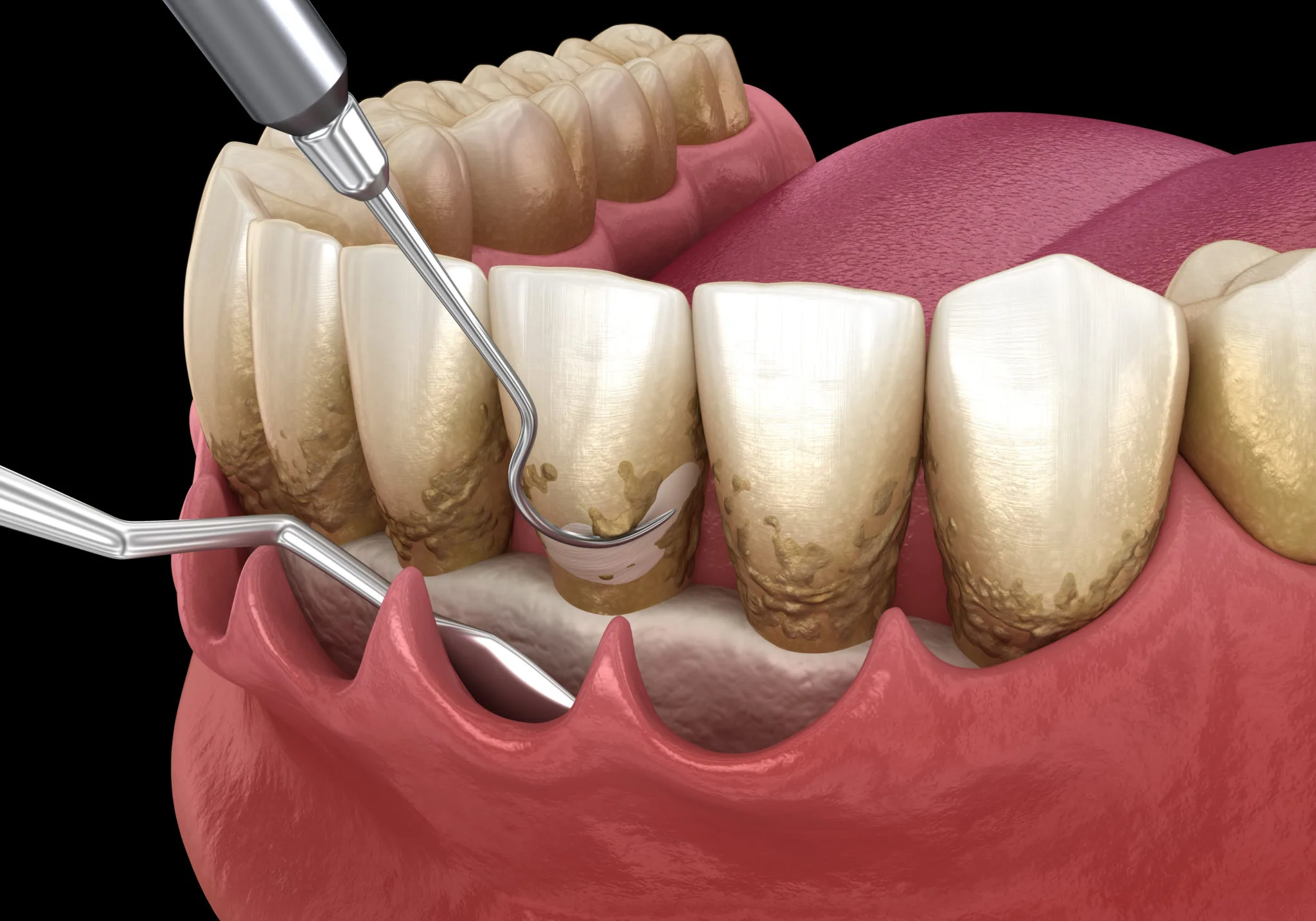 Periodontal Therapy