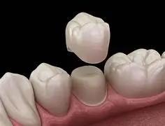 Dental Crowns