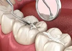 Pit & fissure sealants