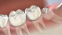 Wisdom Tooth Extractions