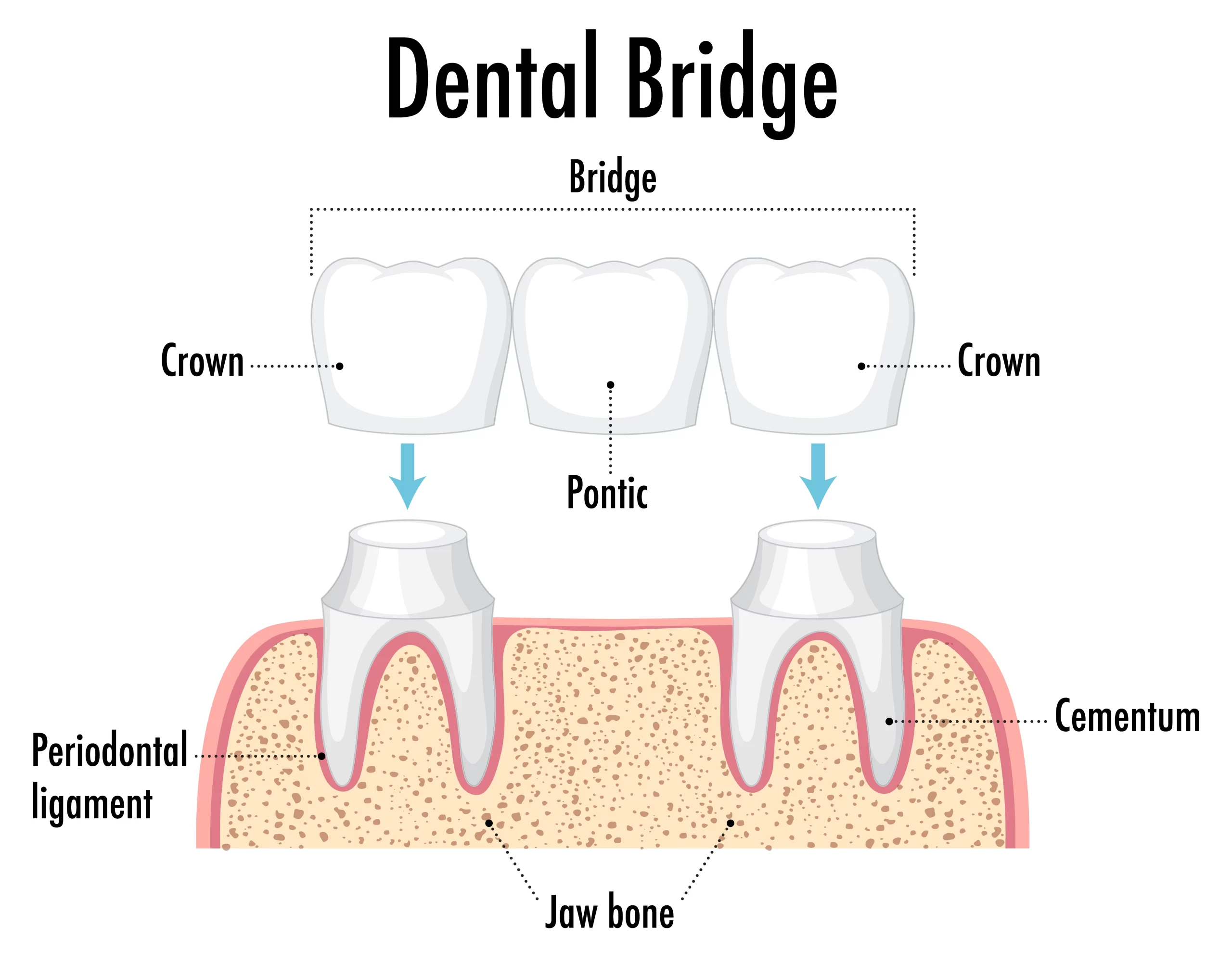 dental bridge